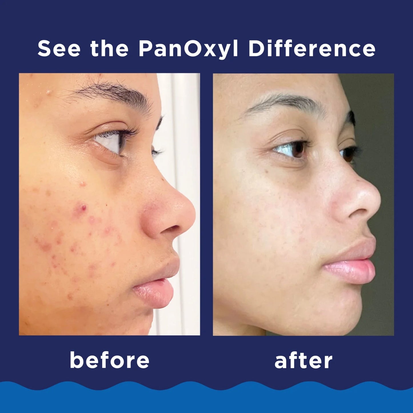 PanOxyl acne foaming wash for face and body